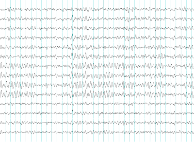 400 ElectroEncephalogram